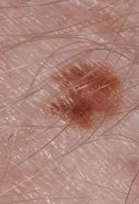 Melanoma that has developed from a suspicious dark mole.