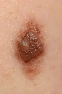 Suspicious irritated mole found not to be melanoma.