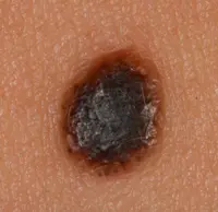 Melanoma that has developed from a long standing mole that is starting to spread.