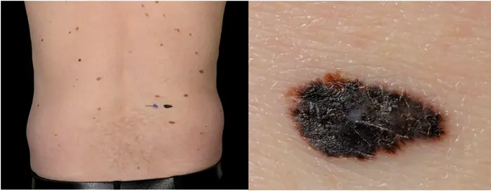 New, dark lesion on the skin proven to be a melanoma.