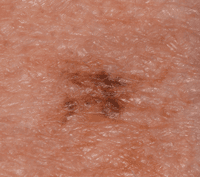 Photo of a lentigo maligna melanoma.