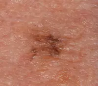 Photo of a lentigo maligna melanoma.
