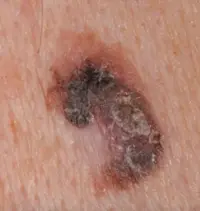 Melanoma from a new, odd-looking, growing lesion on the skin.