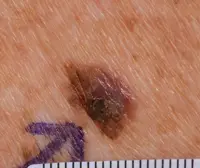 Melanoma that’s not developed from a mole and is starting to spread.