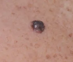 Photo of a nodular melanoma.