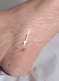 Photo of an acral melanoma.