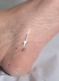 Photo of an acral melanoma.