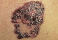 Photograph of pigmented basal cell cancer.