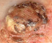 Photograph of squamous cell cancer.