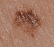Photo of a superficial spreading melanoma.