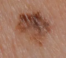 Photo of a superficial spreading melanoma.