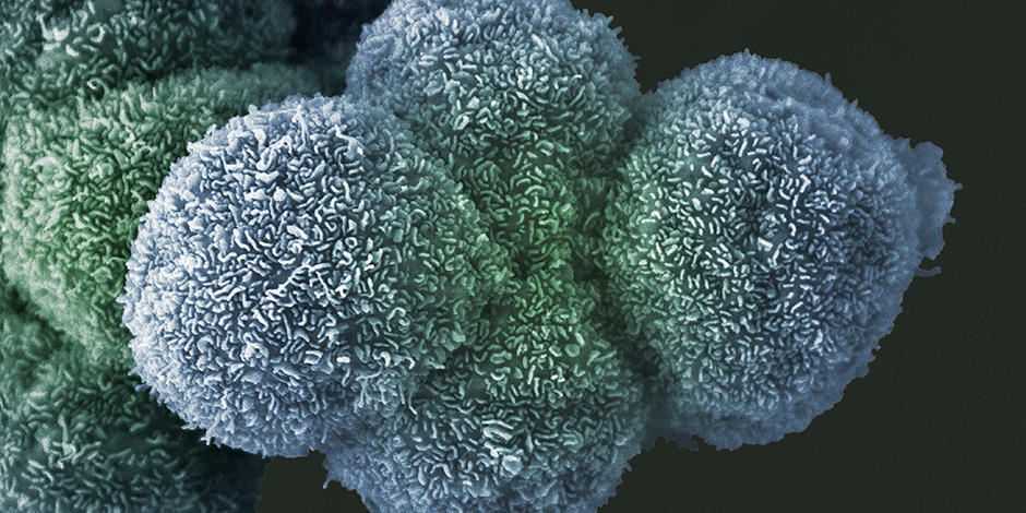 Pancreatic cancer cells (LRI EM Unit) Pancreatic cancer cells (LRI EM Unit)