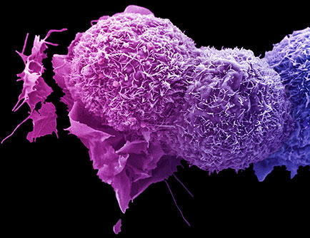 Lung cancer cells under a powerful microscope