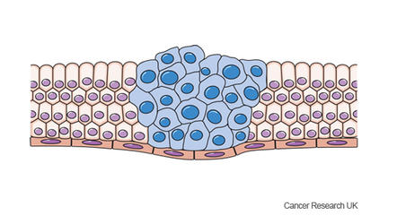 Diagram showing cancer cells
