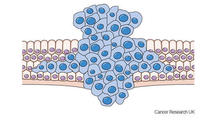 Diagram showing cancer cells growing