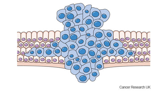 Diagram showing cancer cells growing