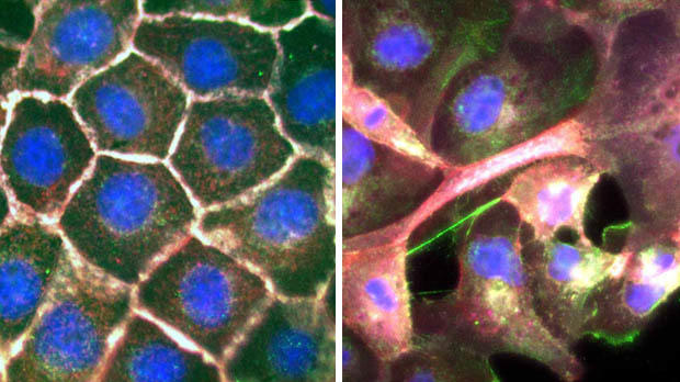 Lung cancer cell spread
