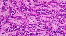 Stomach cancer cells (via Wikimedia Commons) Stomach cancer cells (via Wikimedia Commons)