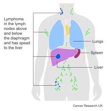 Medical diagram - Lymphoma.