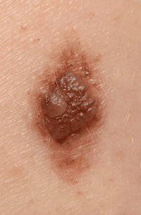 Suspicious irritated mole found not to be melanoma.