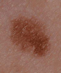 Melanoma from a mole that was once an even colour and shape but has now changed.