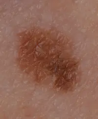 Melanoma from a mole that was once an even colour and shape but has now changed.