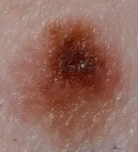 Melanoma from a mole with changing shape and colour.