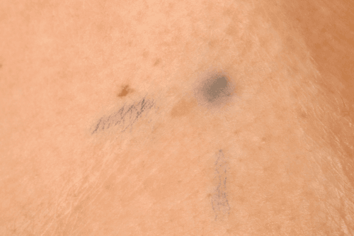 Trial 5_PI_Photo entity_ Radiotherapy tattoo mark.
