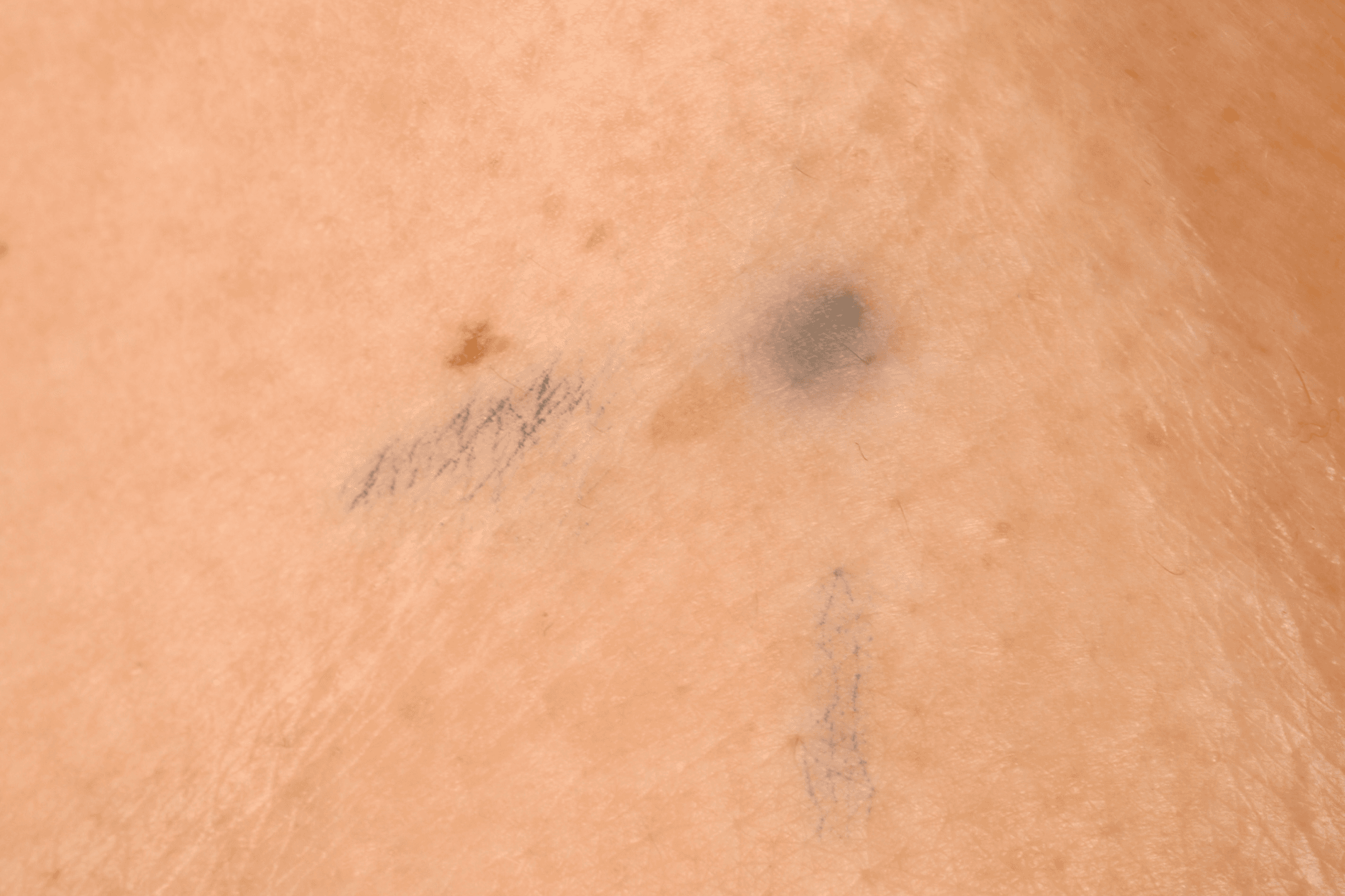 Photograph showing radiotherapy tattoo marks.