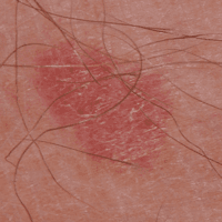 Photo of an amelanotic melanoma.