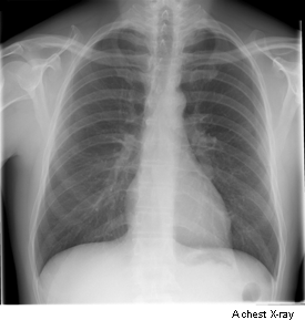Photograph showing a chest x-ray .