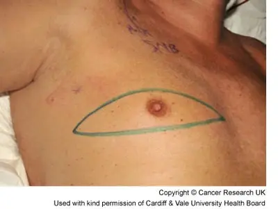 Photograph of the area to be removed during a mastectomy for this mans breast cancer.