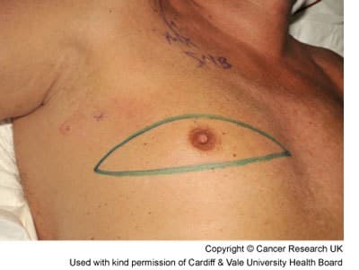 Photograph of the area to be removed during a mastectomy for this mans breast cancer.