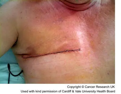 Photograph of a man 1 day after a mastectomy.