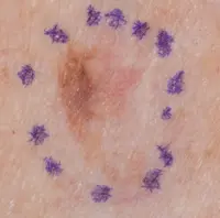 Melanoma that has developed from a changing area of the skin with irregular shape and colour.