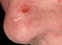 Photograph of morphoeic basal cell carcinoma.