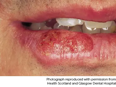 Photo showing cancer on lip.