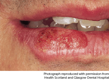 Photo showing cancer on lip.