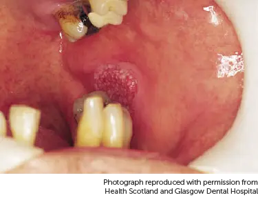 Photo showing mouth cancer.