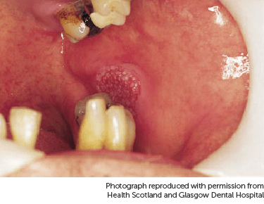 Photo showing mouth cancer.