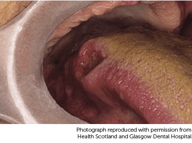 Photo showing cancer on the tongue.