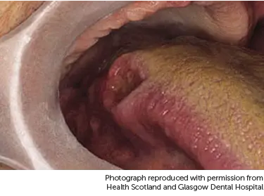 Photo showing cancer on the tongue.