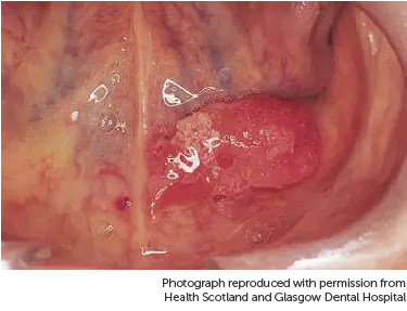Photograph showing mouth cancer under tongue.