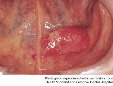 Photograph showing mouth cancer under tongue.