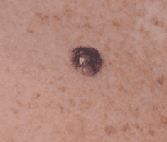 Photo of a nodular melanoma.