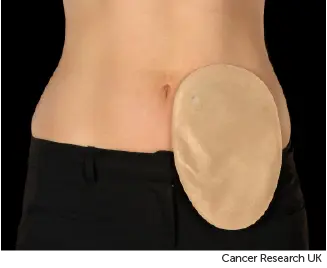 Photo showing one type of colostomy bag.
