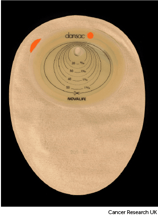 Photo showing the back of a colostomy bag.