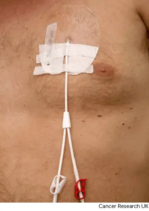 Photograph of a central line .