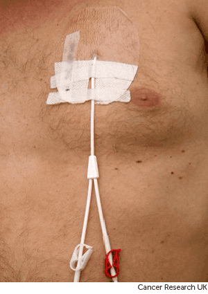 Photograph of a central line .