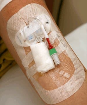 Photograph of a PICC line on an arm.